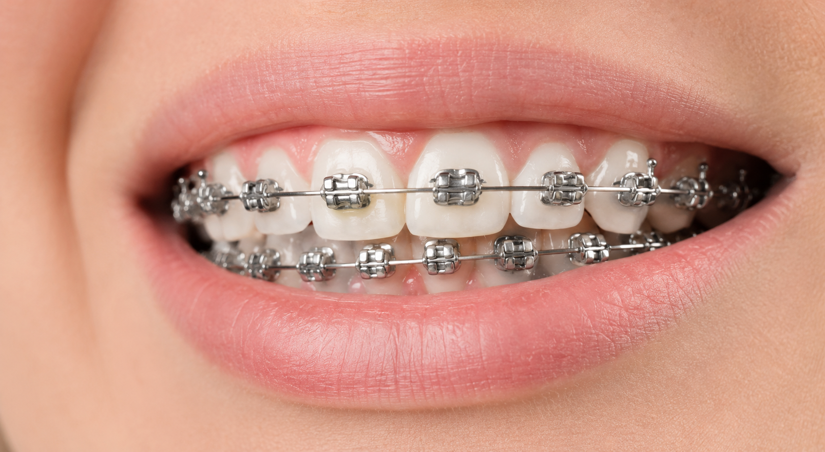 Brackets autoligables